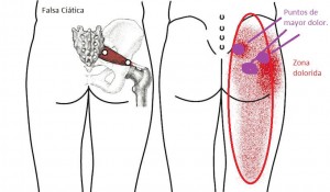 Lumbalgia